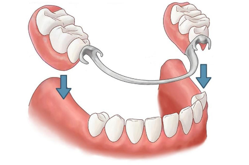 Removal Partial Dentures Tooth